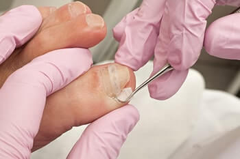 Surgery for ingrowing toenail (adult)